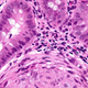 Very high magnification micrograph of Crohn’s disease.